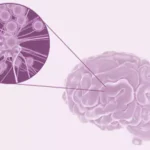 التهاب الدماغ (Encephalitis)