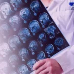اعتلال الدماغ (Encephalopathy)