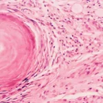 الورم السحائي (Meningioma)