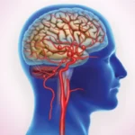 تمدد الأوعية الدموية في المخ