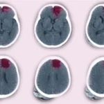 الآفات الدماغية