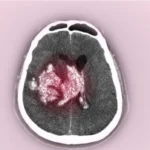 الكدمة الدماغية والورم الدموي داخل الدماغ