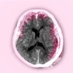 الورم الدموي فوق الجافية الورم الدموي فوق الجافية (Epidural Hematoma)