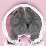 الورم الدموي تحت الجافية الحاد