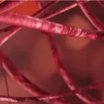 التشوه الشرياني الوريدي (Arteriovenous Malformation - AVM)