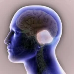 أورام الزاوية المخيخية الجسرية CPA