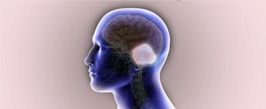 cerebellopontine-angle-tumor