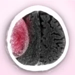 الورم الدموي تحت الجافية المزمن