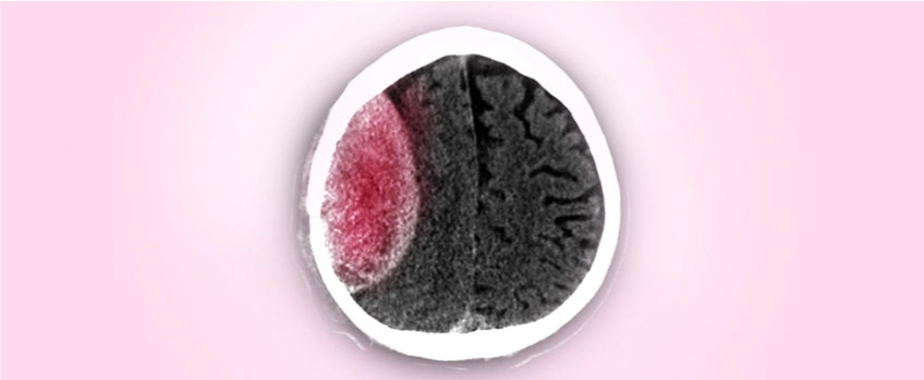 chronic-subdural-hematoma