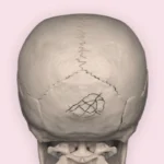 كسور الجمجمة