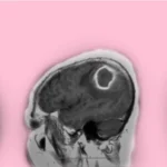 الصرع الناجم عن الأورام أو تشوهات الأوعية الدموية
