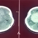 ورم قاعدة الجمجمة