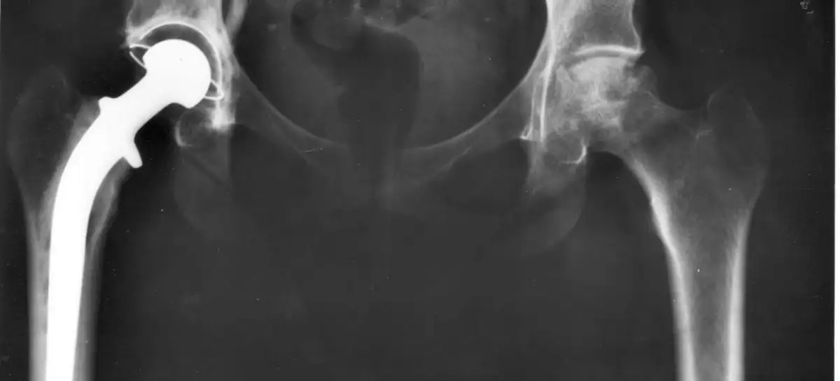 استبدال مفصل الورك