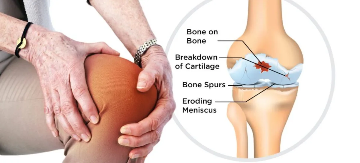 أسباب وأعراض وعلاج هشاشة العظام