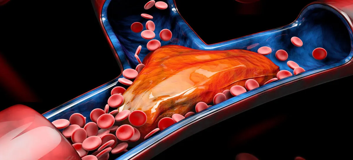 تفتيت الخثرة واستئصال الخثرة ميكانيكيًا