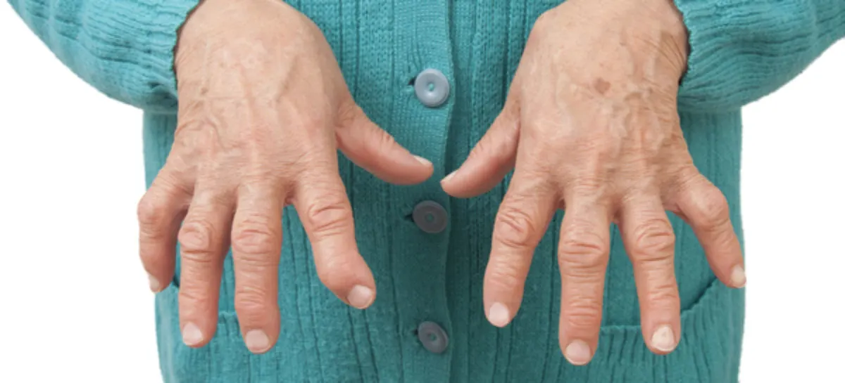 ما هو التهاب المفاصل الروماتويدي؟